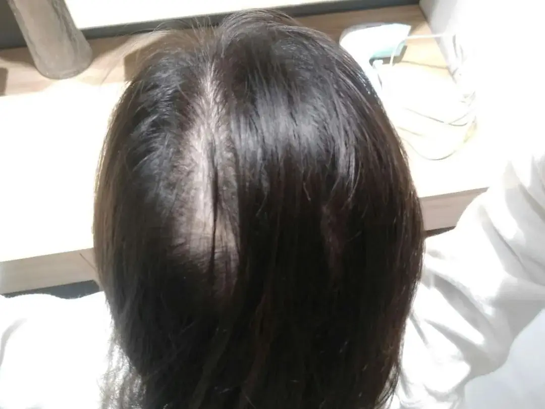 掉发脱发严重是什么原因