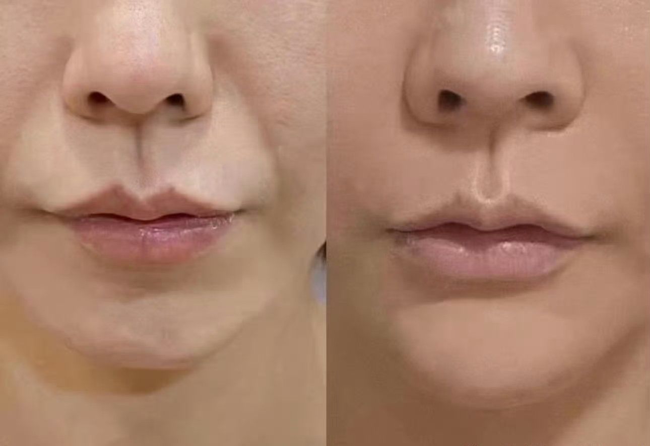 ps去法令纹教程