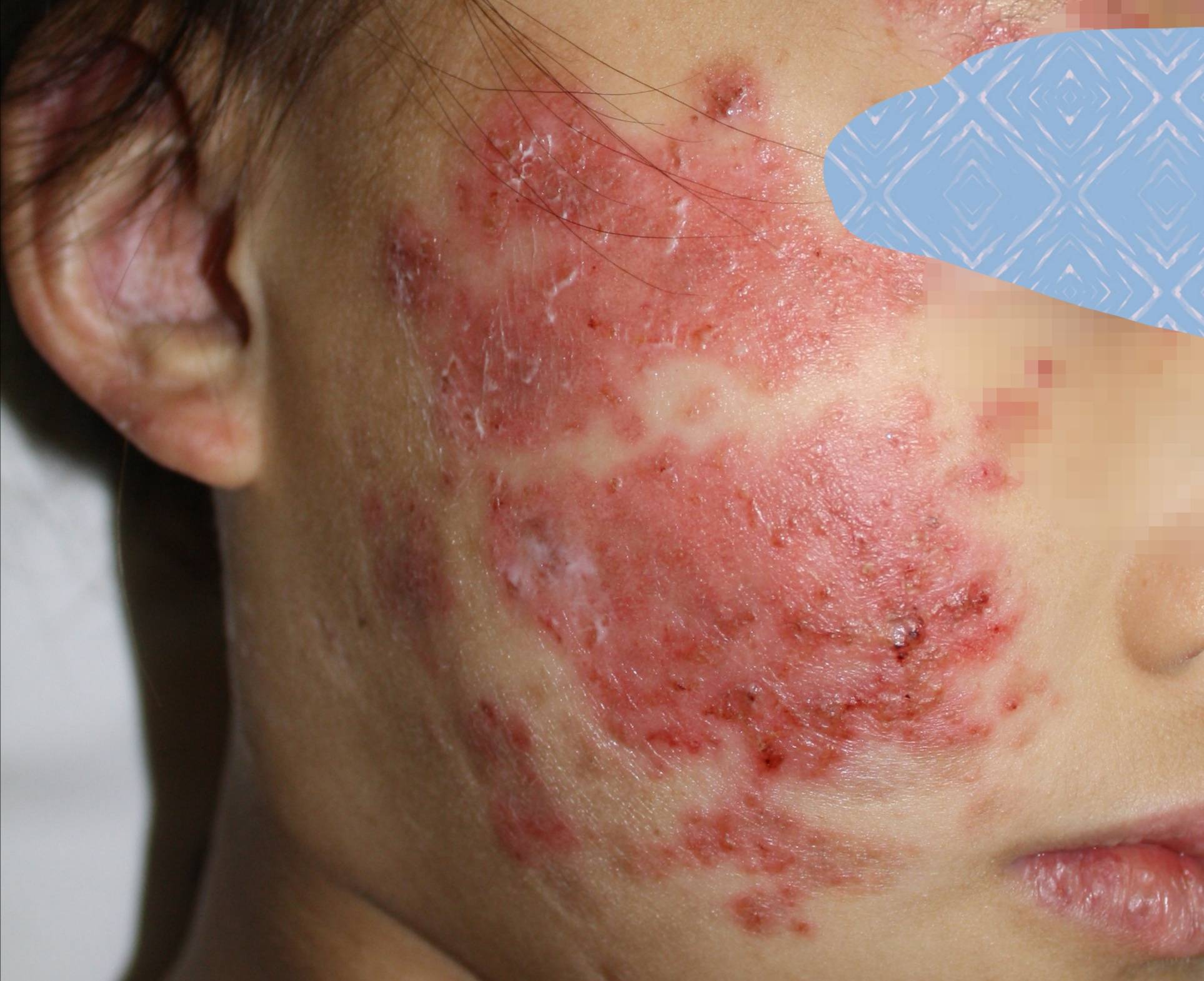 系统性红斑狼疮图片