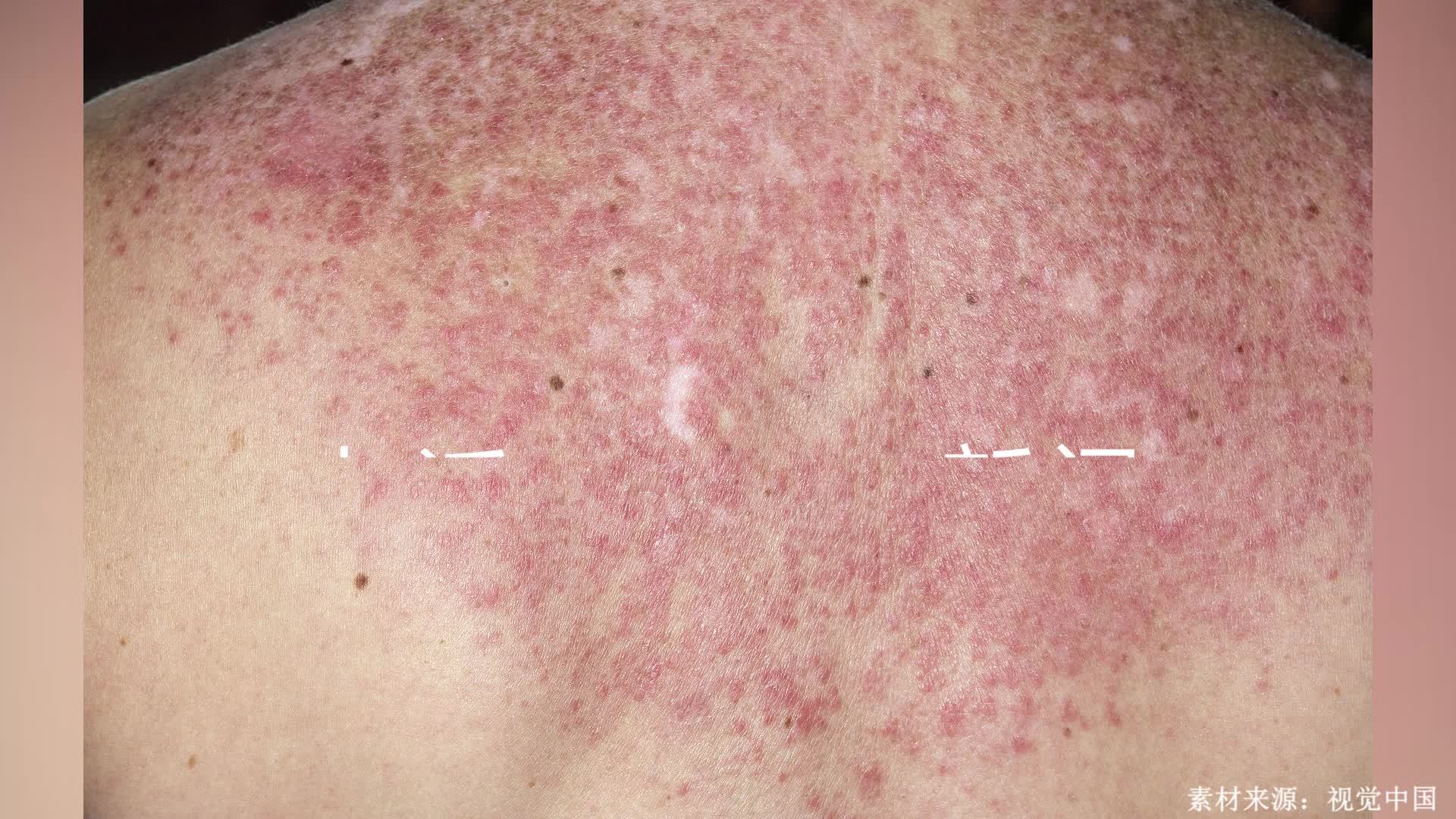 系统性红斑狼疮图片