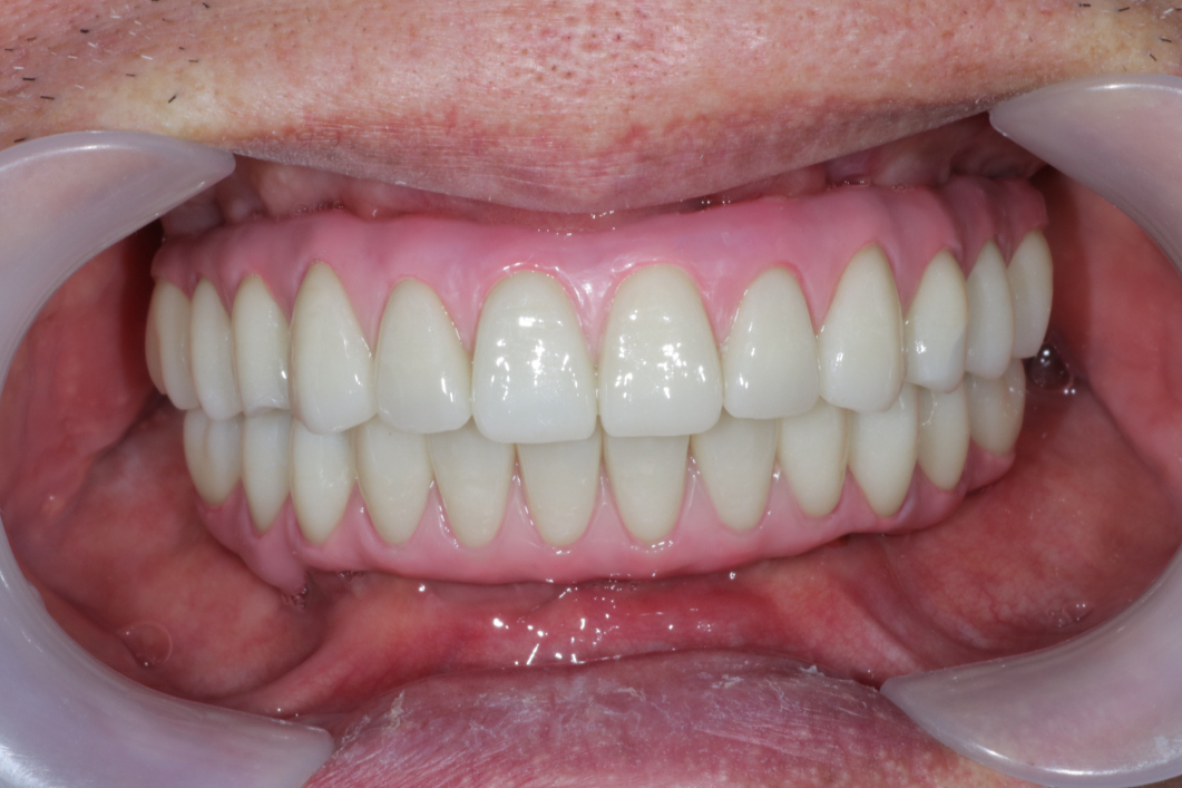 一位知名人士透露，柳州桑拿按摩论坛避坑指南：如何省30%费用+全流程解析