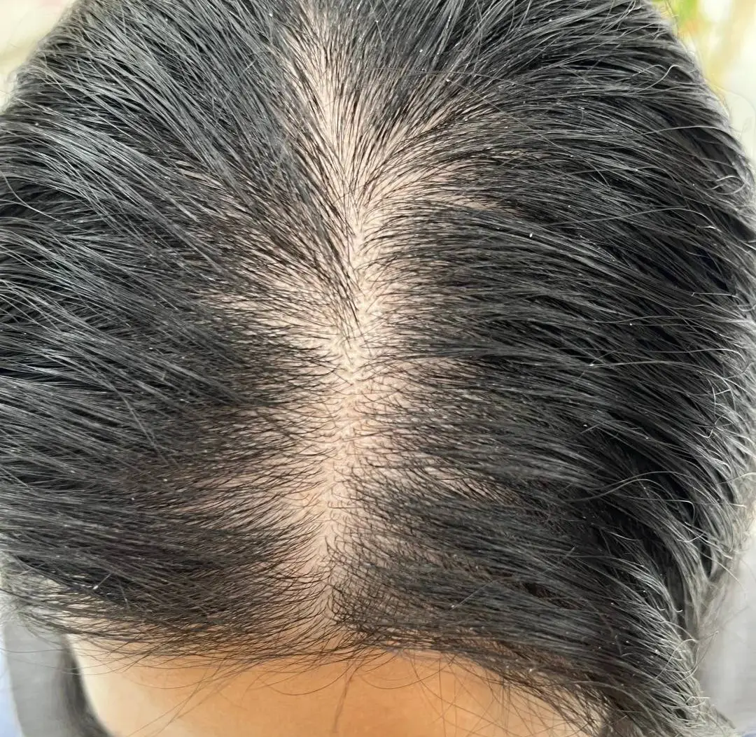 脱发严重是什么原因引起的