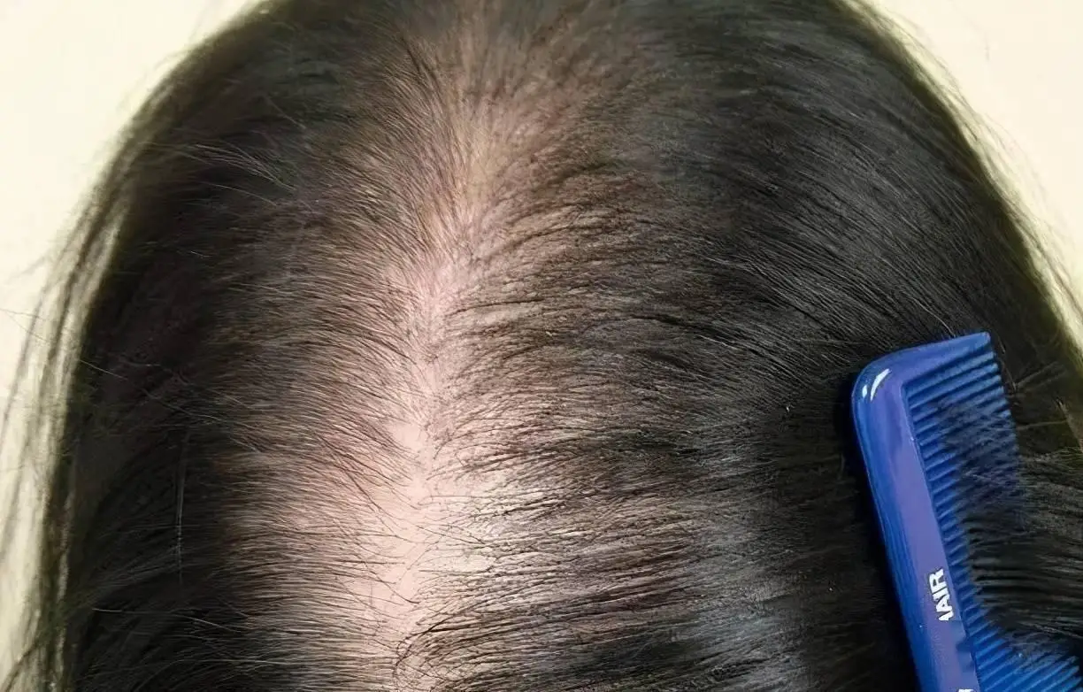 脱发严重是什么原因引起的